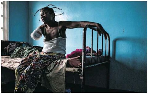 Amputée d'un bras aprés une blessure par balle, une femme se repose sur  son lit dans la Ville de Tshikapa. 