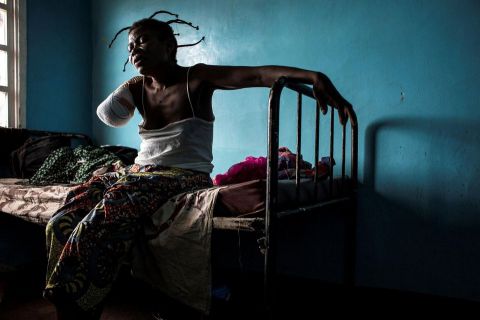 Une Congolaise amputée après avoir été blessée dans le Kasaï. Le 23 octobre, à Tshikapa en RDC. 